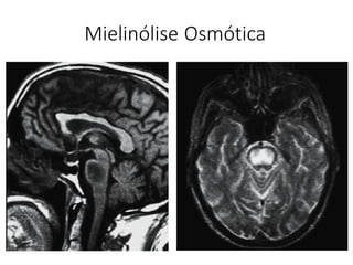 Mielinólise Osmótica
 