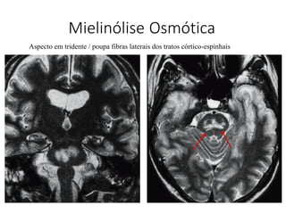 Mielinólise Osmótica
Aspecto em tridente / poupa fibras laterais dos tratos córtico-espinhais
 