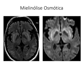 Mielinólise Osmótica
 