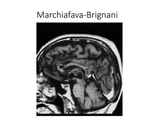 Marchiafava-Brignani
 