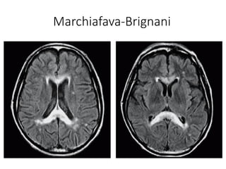 Marchiafava-Brignani
 