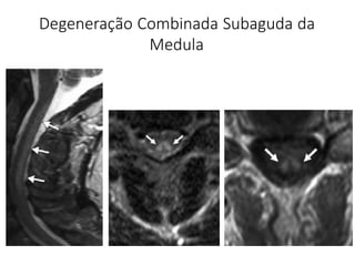 Degeneração Combinada Subaguda da
Medula
 