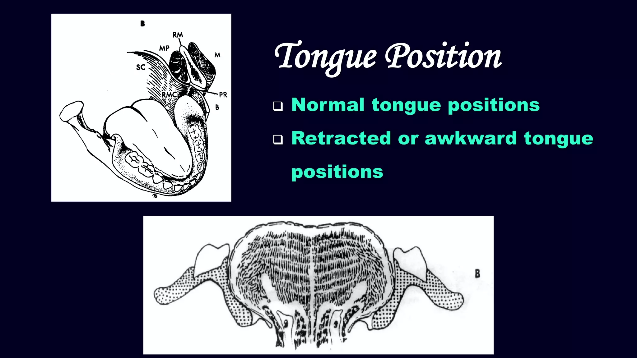 Tongue Position
 Normal tongue positions
 Retracted or awkward tongue
positions
 