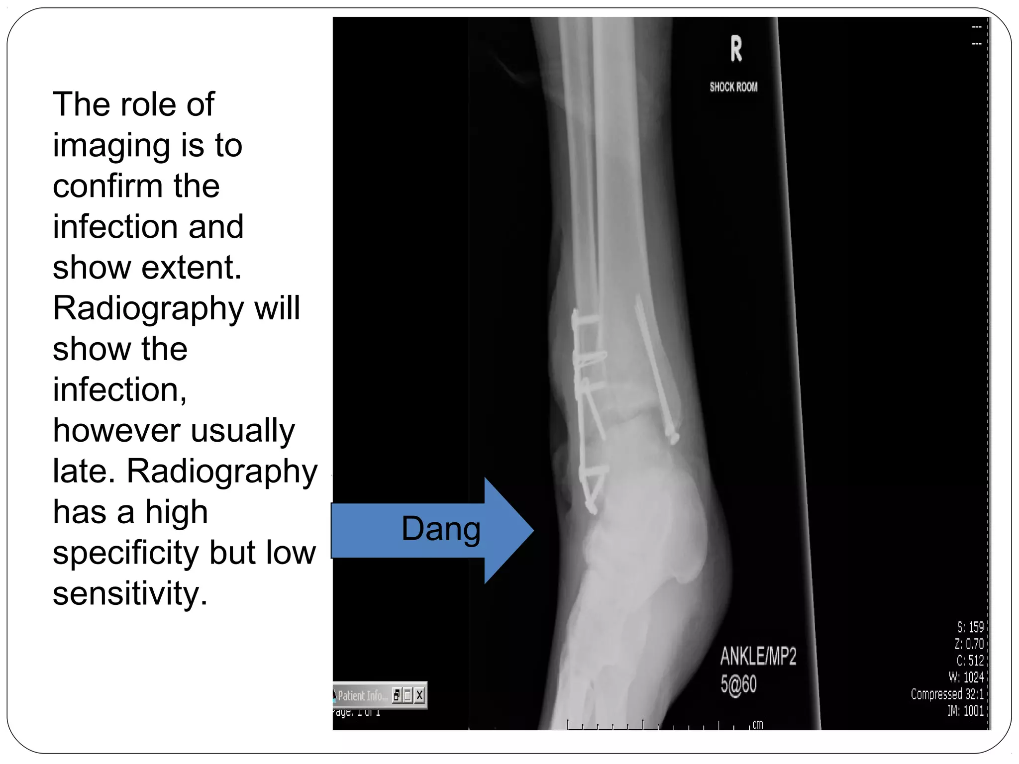 Dang
The role of
imaging is to
confirm the
infection and
show extent.
Radiography will
show the
infection,
however usually
late. Radiography
has a high
specificity but low
sensitivity.
 