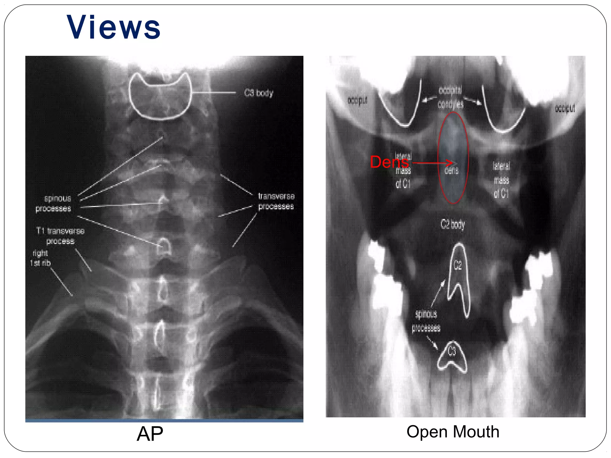 Views
AP Open Mouth
Dens
 