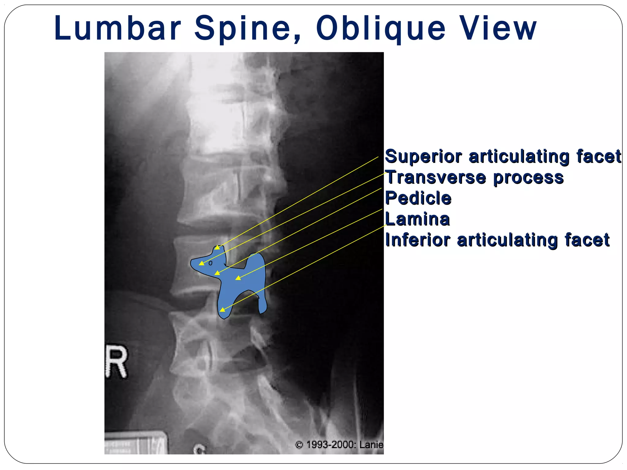Superior articulating facetSuperior articulating facet
Transverse processTransverse process
PediclePedicle
LaminaLamina
Inferior articulating facetInferior articulating facet
Lumbar Spine, Oblique View
 