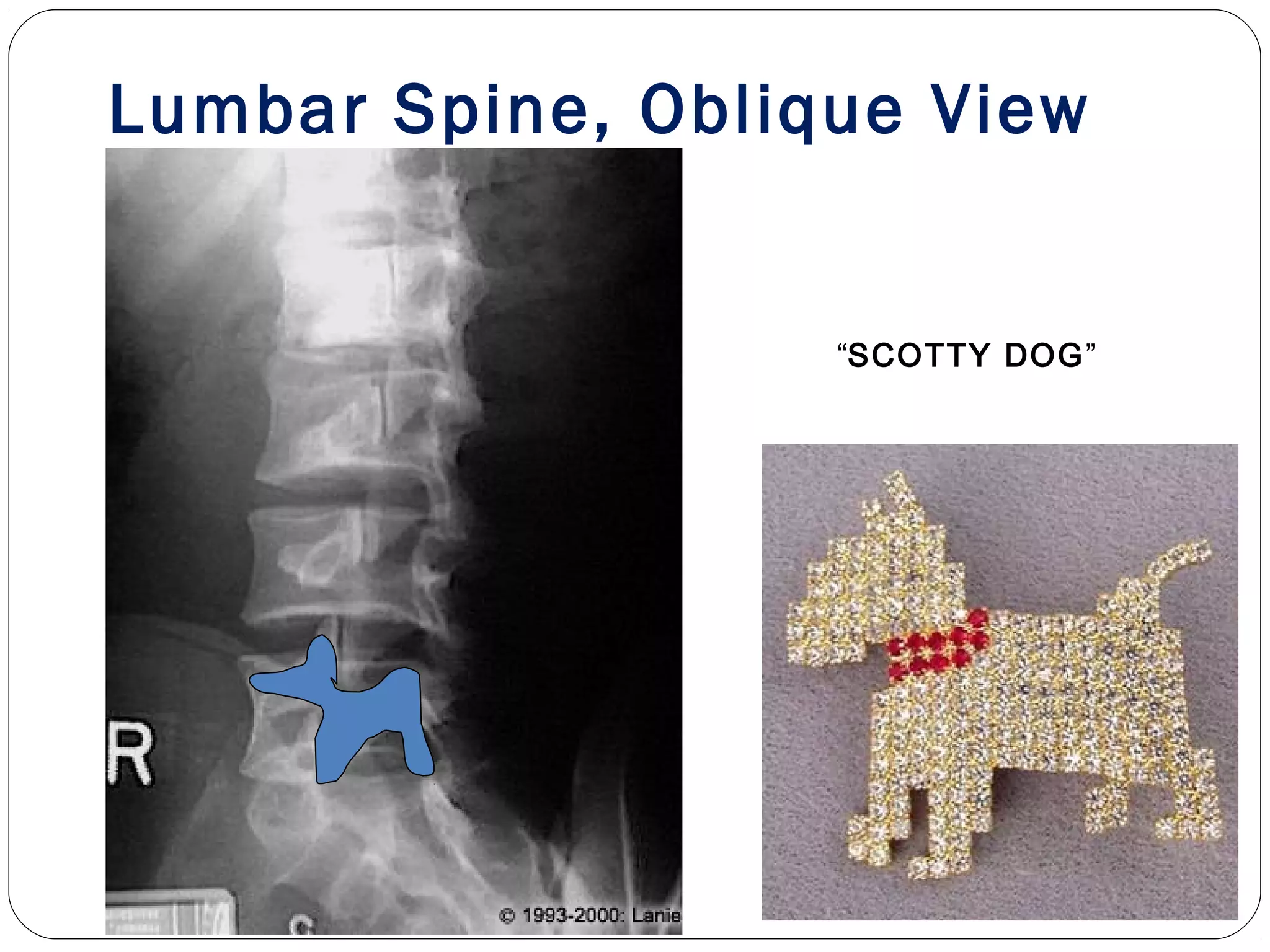 Lumbar Spine, Oblique View
“SCOTTY DOG”
 