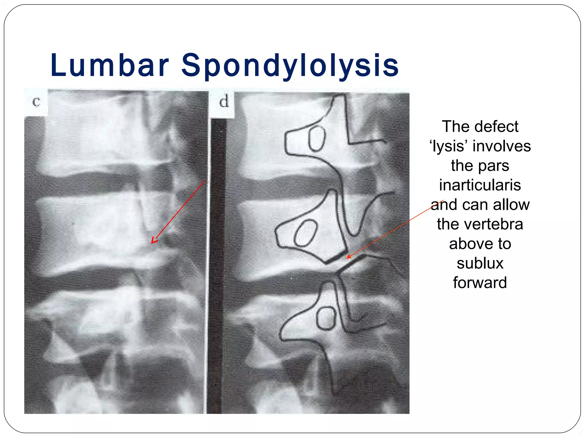 Lumbar Spondylolysis
The defect
‘lysis’ involves
the pars
inarticularis
and can allow
the vertebra
above to
sublux
forward
 