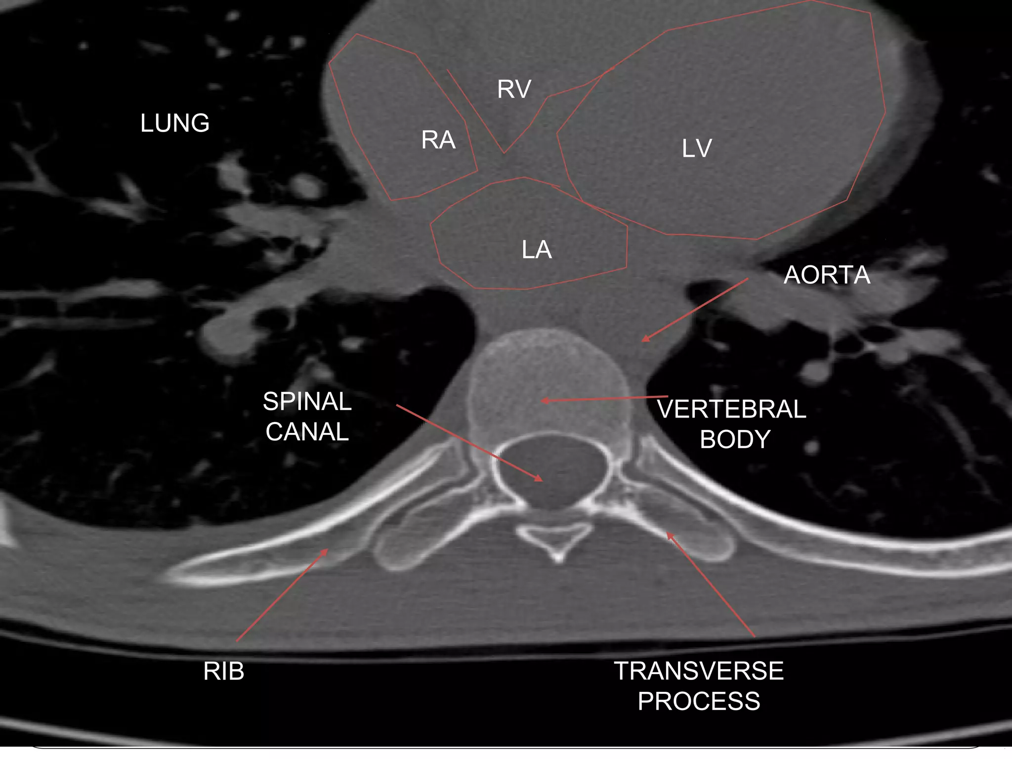 LV
VERTEBRAL
BODY
SPINAL
CANAL
TRANSVERSE
PROCESS
RIB
LUNG
RA
LA
RV
AORTA
 