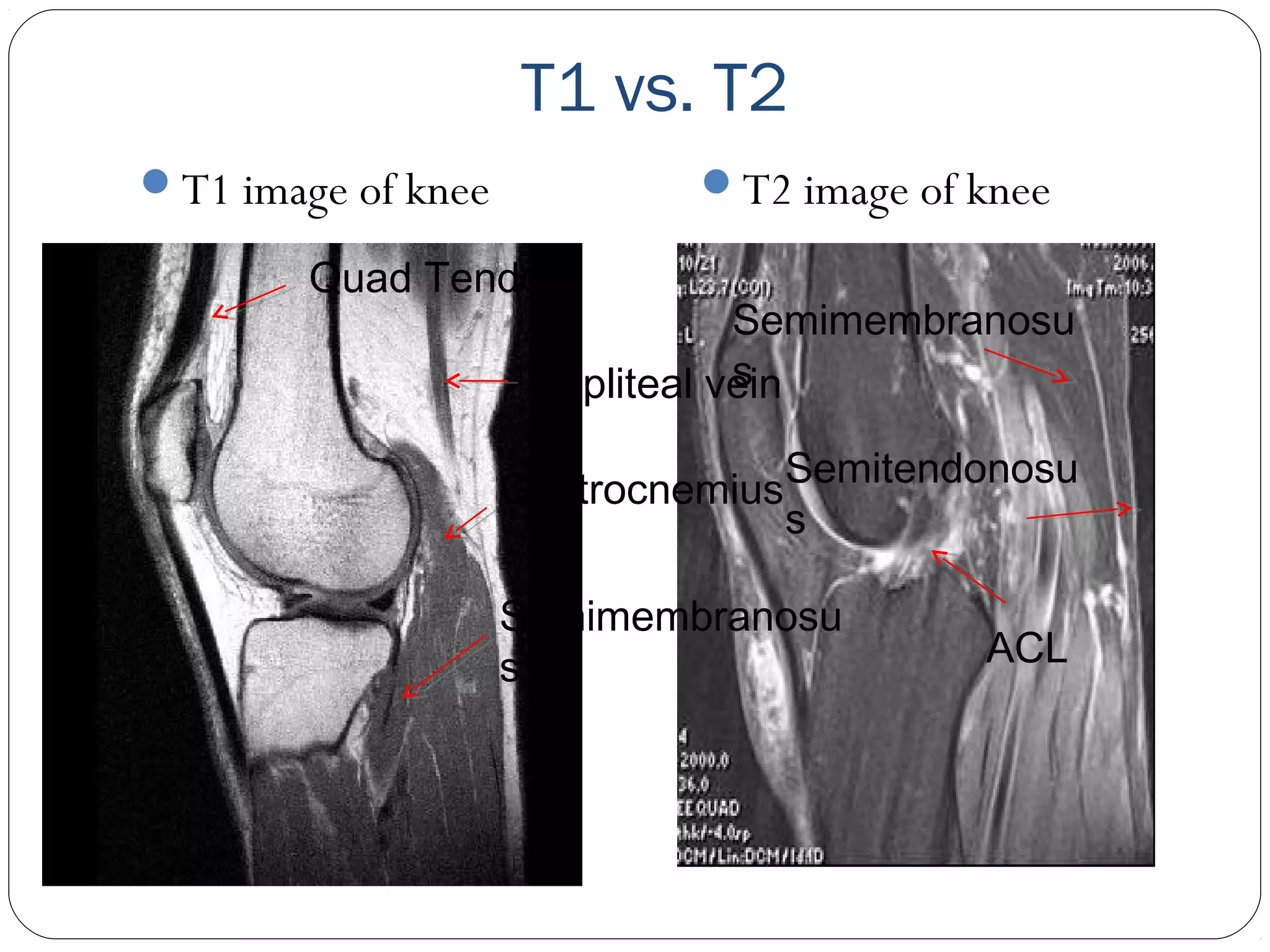 T1 vs. T2
T1 image of knee T2 image of knee
Gastrocnemius
Semimembranosu
s
Popliteal vein
Quad Tendon
Semimembranosu
s
ACL
Semitendonosu
s
 