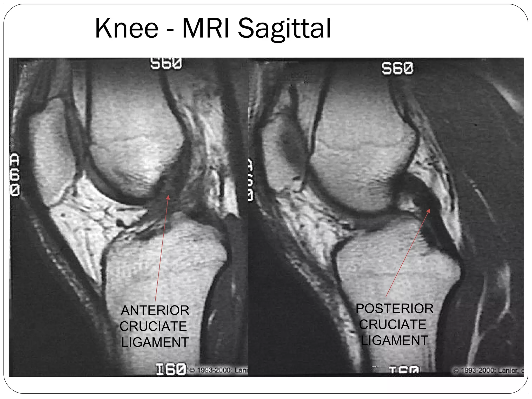 Knee - MRI Sagittal
ANTERIOR
CRUCIATE
LIGAMENT
POSTERIOR
CRUCIATE
LIGAMENT
 