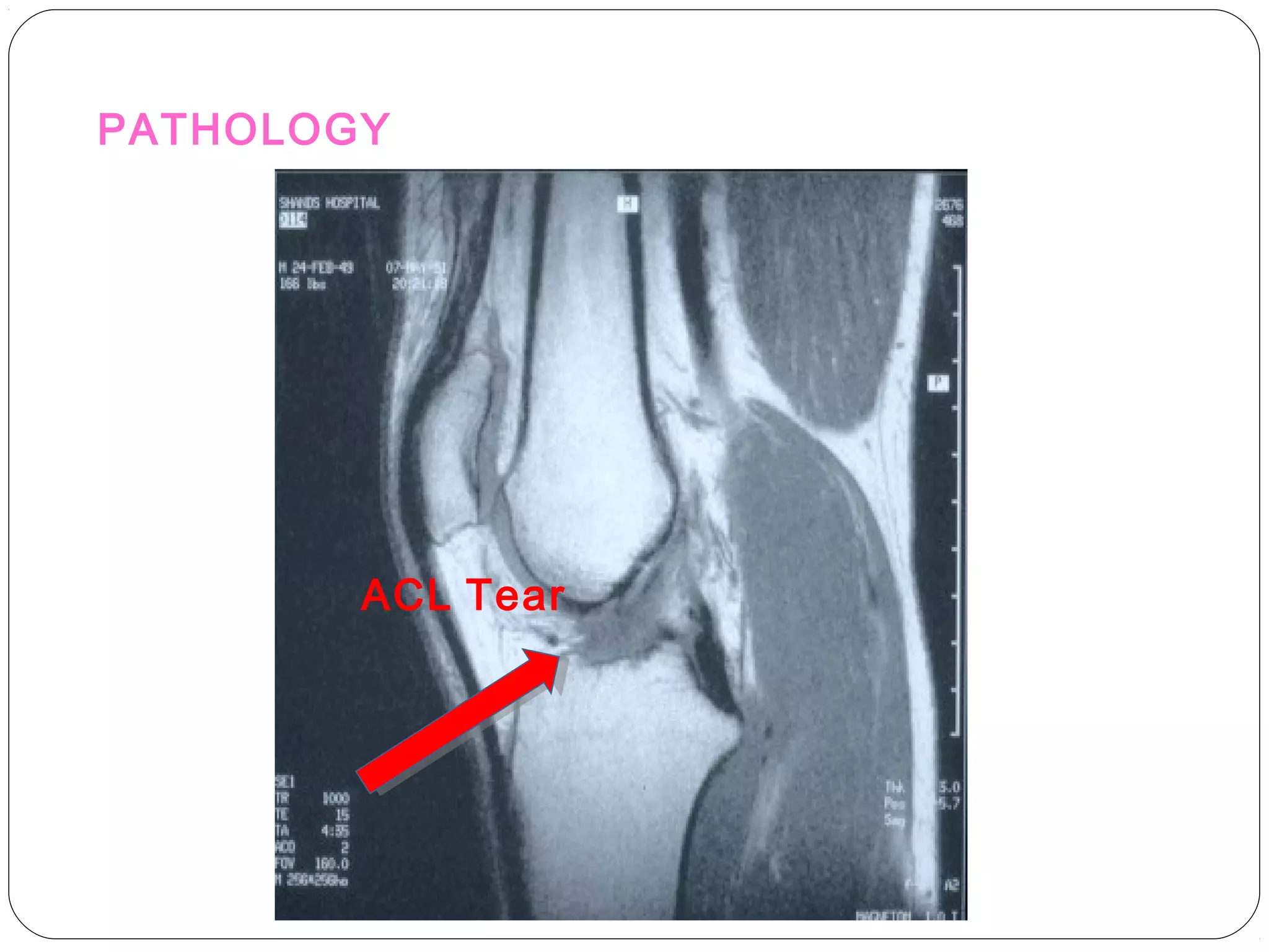 PATHOLOGY
ACL Tear
 