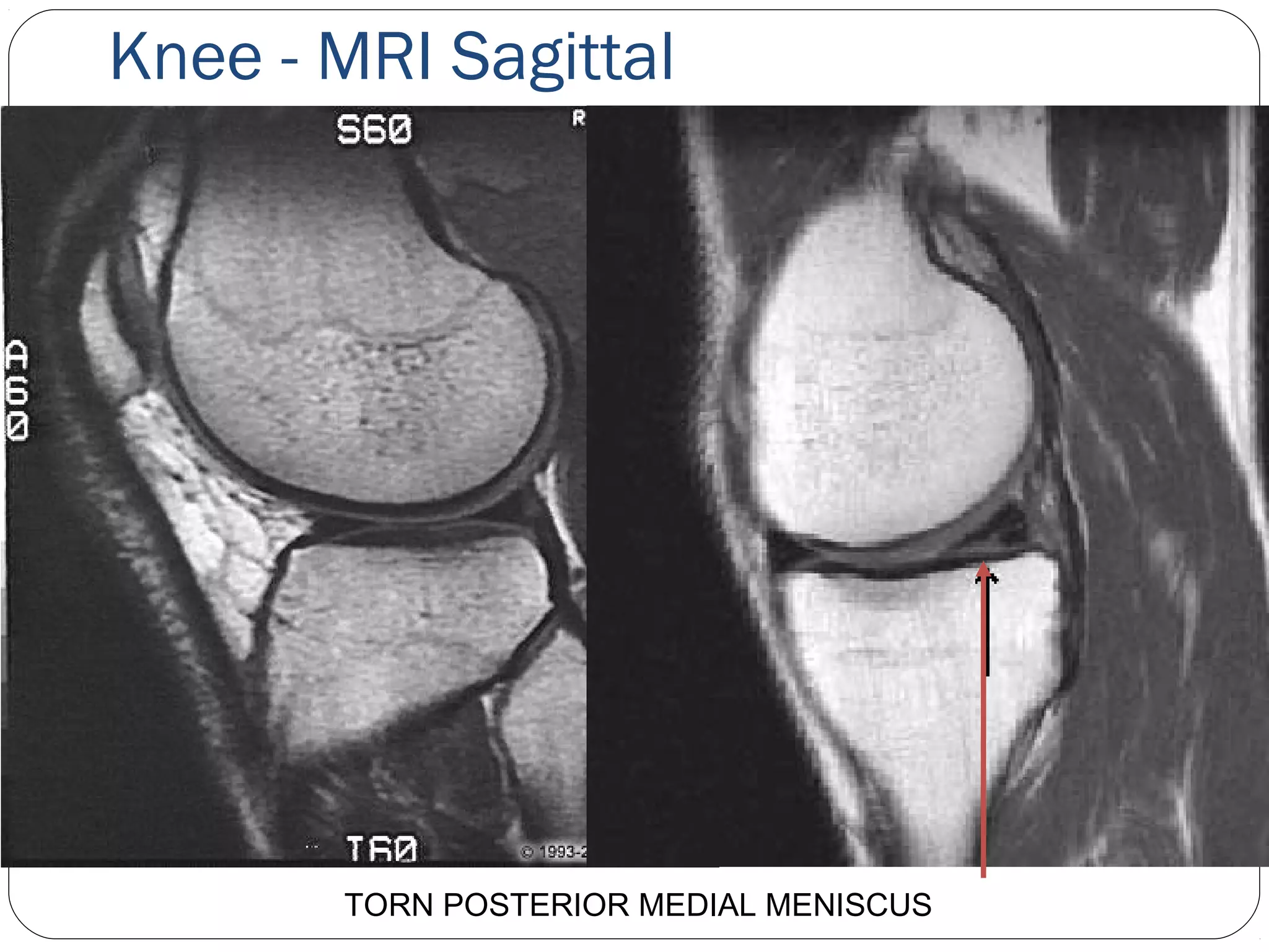 Knee - MRI Sagittal
TORN POSTERIOR MEDIAL MENISCUS
 
