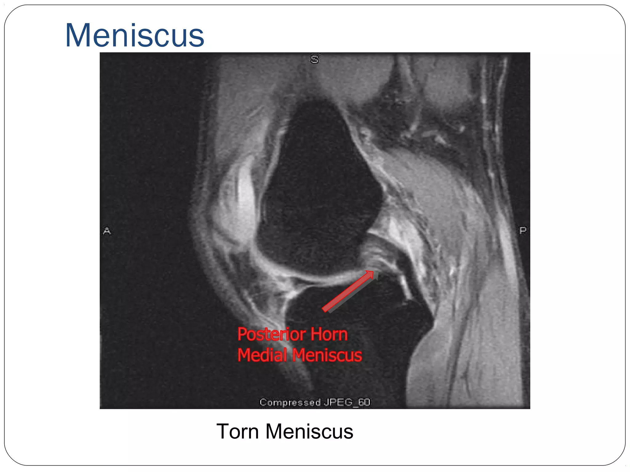 Meniscus
Torn Meniscus
 