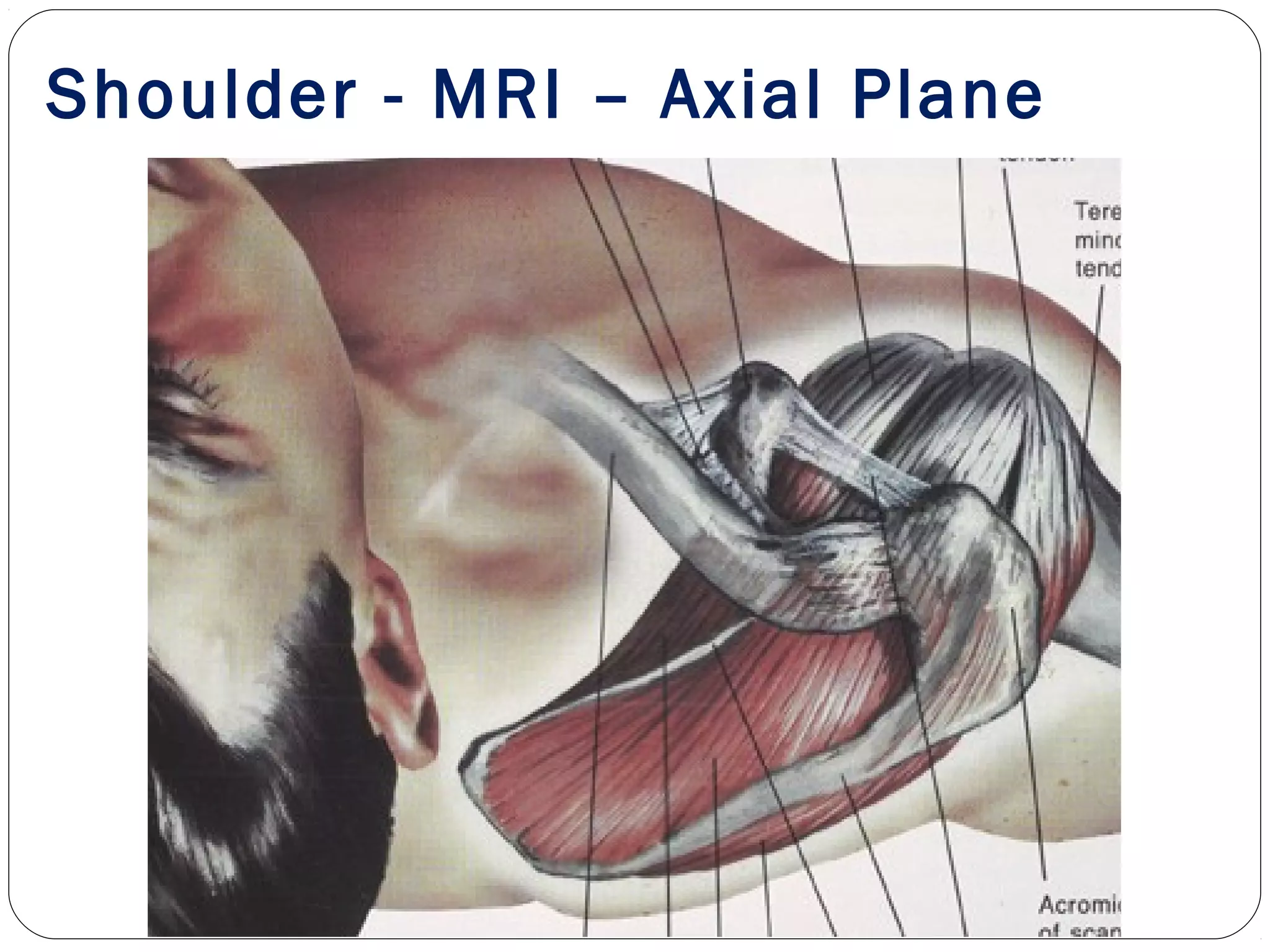 Shoulder - MRI – Axial Plane
 