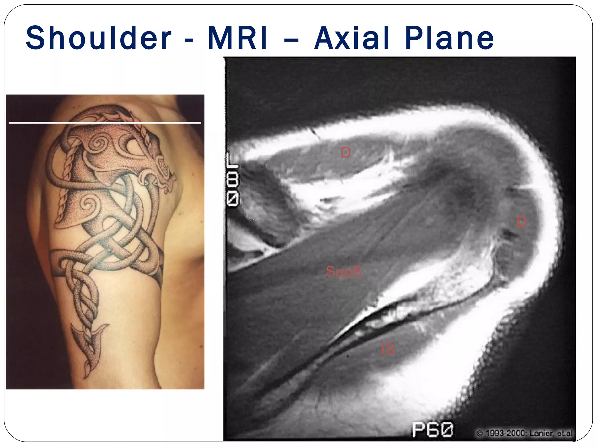 SupS
D
D
IS
Shoulder - MRI – Axial Plane
 