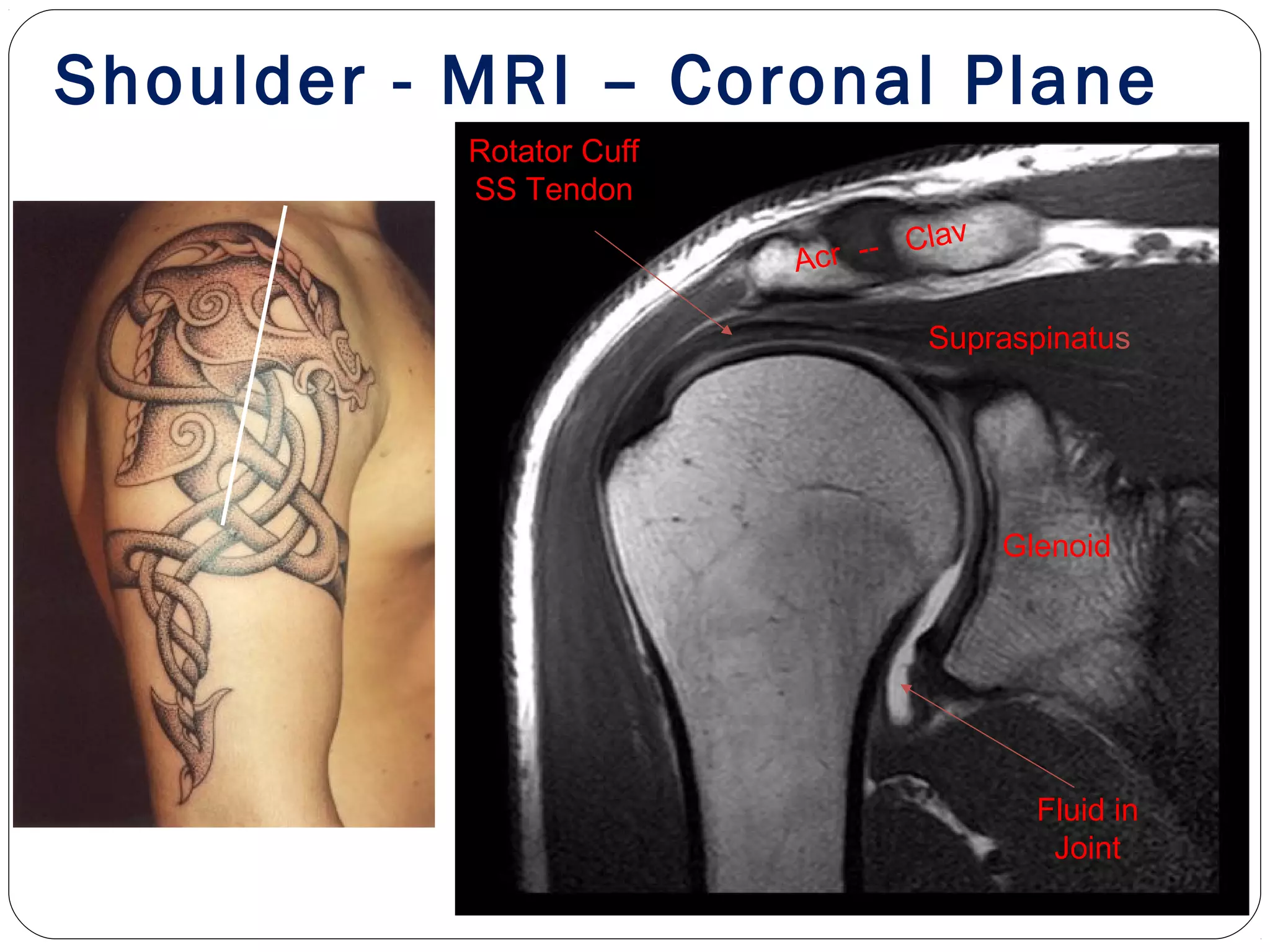 Shoulder - MRI – Coronal Plane
Supraspinatus
Rotator Cuff
SS Tendon
Fluid in
Joint
Glenoid
Acr -- Clav
 