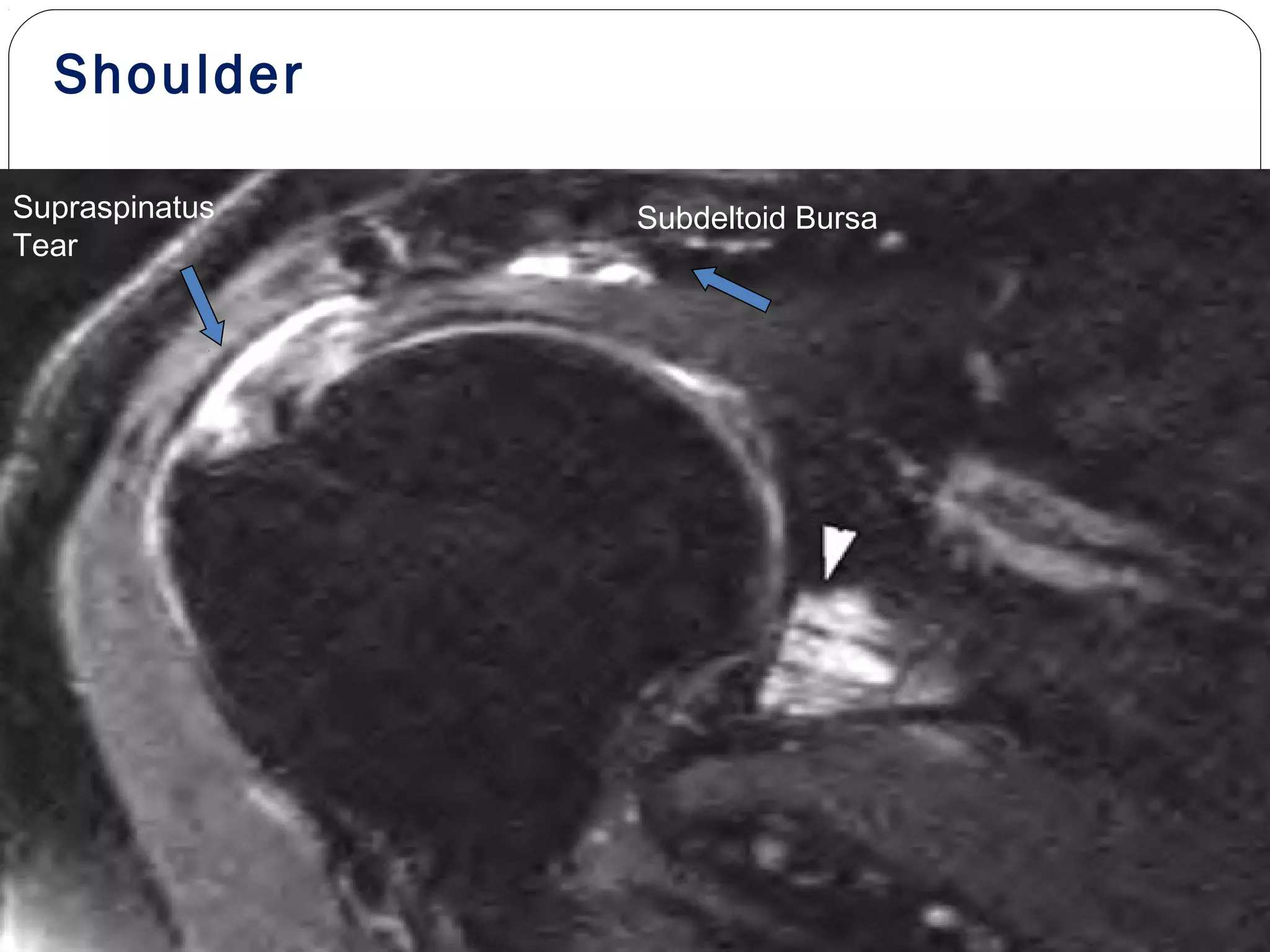 Shoulder
Supraspinatus
Tear
Subdeltoid Bursa
 