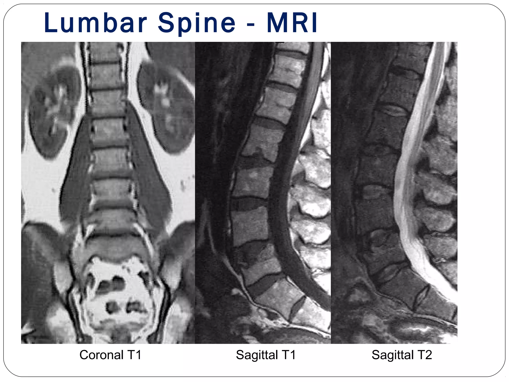 Lumbar Spine - MRI
Coronal T1 Sagittal T1 Sagittal T2
 