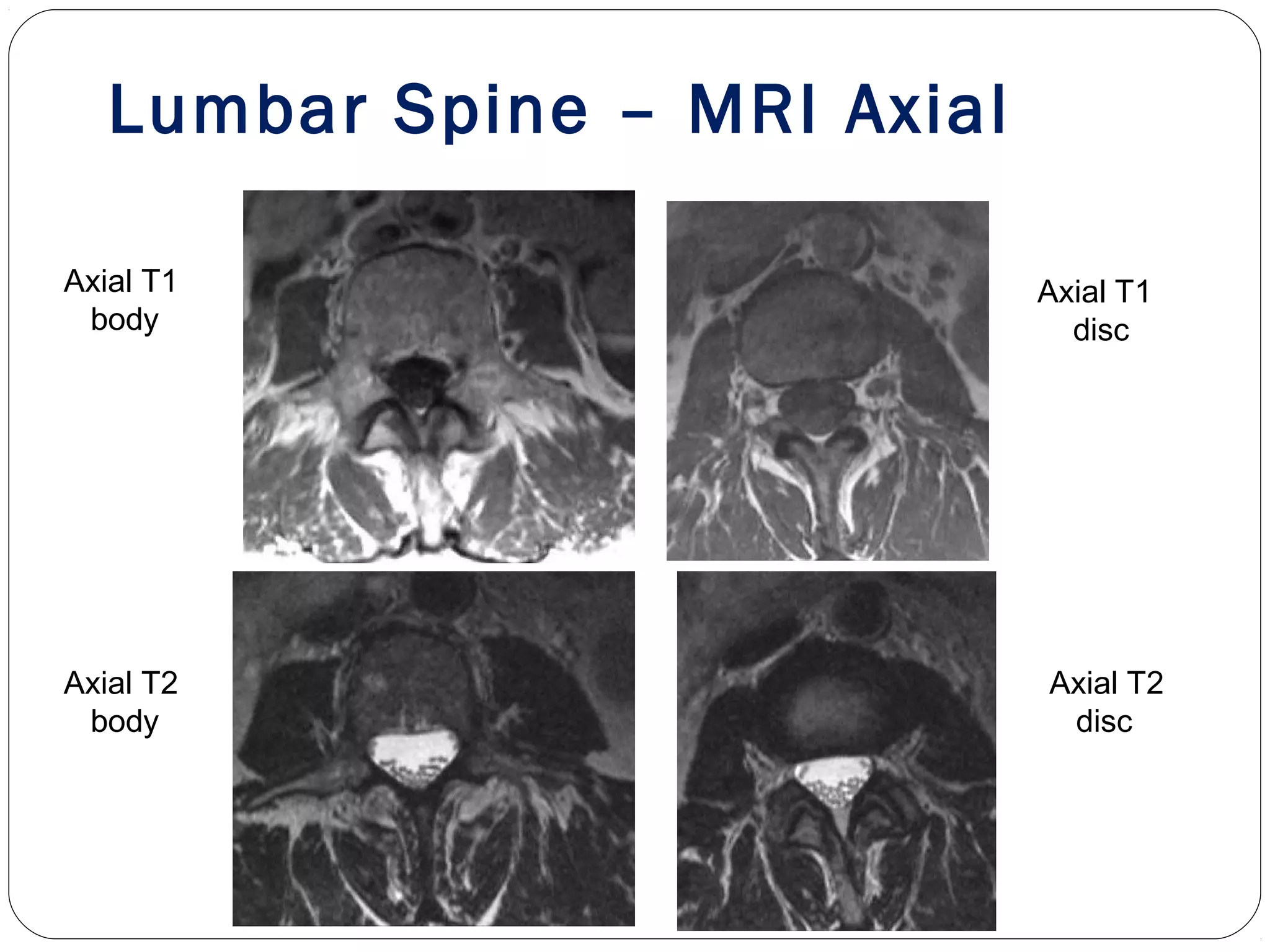 Axial T1
body
Axial T1
disc
Axial T2
body
Axial T2
disc
Lumbar Spine – MRI Axial
 