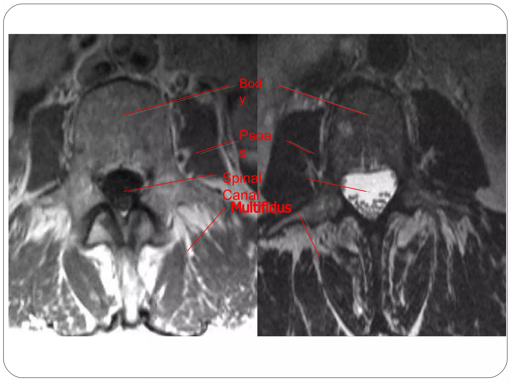 Bod
y
Psoa
s
Spinal
Canal
 
