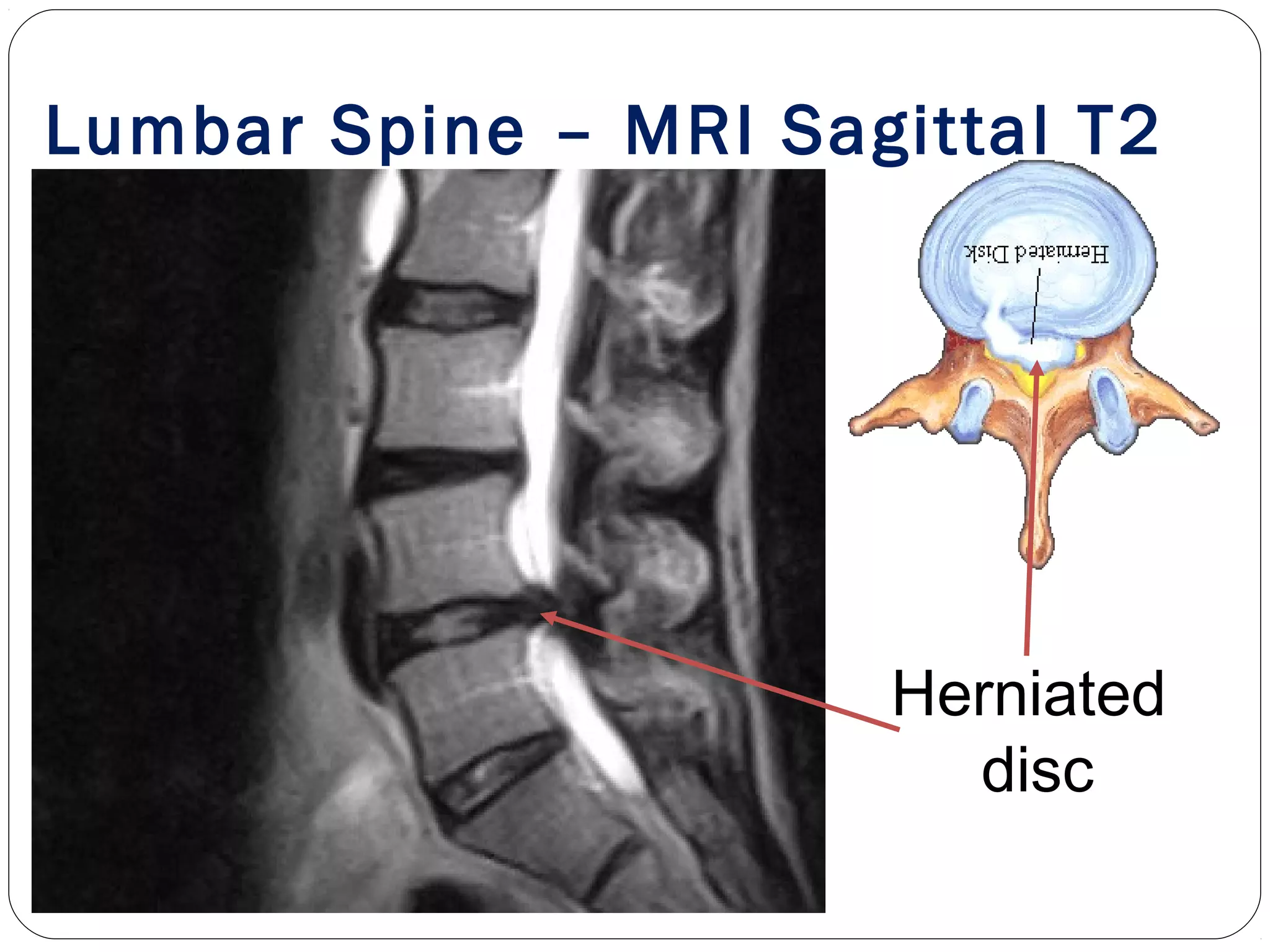 Herniated
disc
Lumbar Spine – MRI Sagittal T2
 