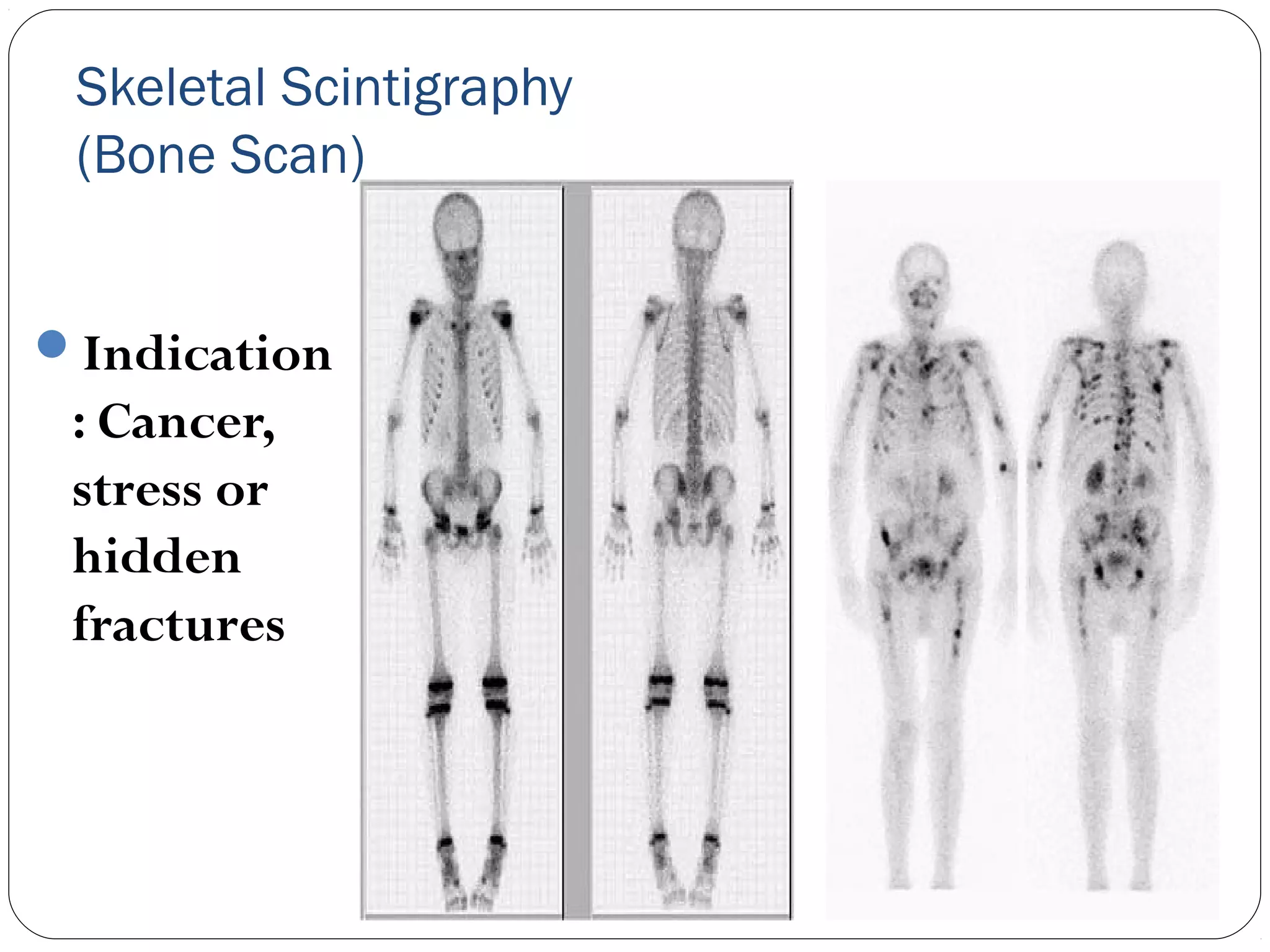 Skeletal Scintigraphy
(Bone Scan)
Indication
: Cancer,
stress or
hidden
fractures
 