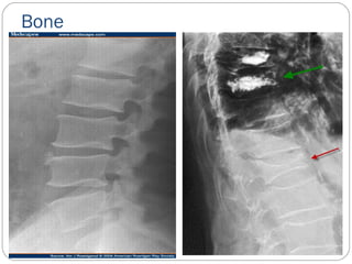 Bone
 