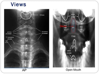 Views
AP Open Mouth
Dens
 