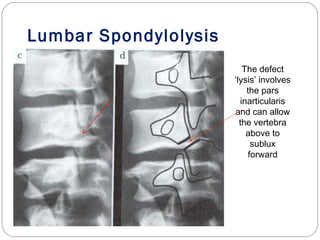 Lumbar Spondylolysis
The defect
‘lysis’ involves
the pars
inarticularis
and can allow
the vertebra
above to
sublux
forward
 
