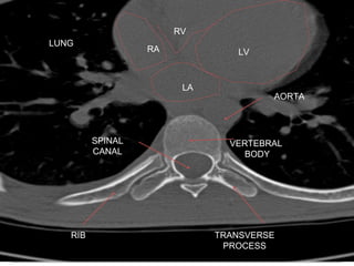 LV
VERTEBRAL
BODY
SPINAL
CANAL
TRANSVERSE
PROCESS
RIB
LUNG
RA
LA
RV
AORTA
 