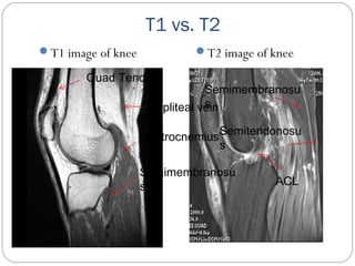T1 vs. T2
T1 image of knee T2 image of knee
Gastrocnemius
Semimembranosu
s
Popliteal vein
Quad Tendon
Semimembranosu
s
ACL
Semitendonosu
s
 