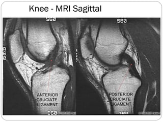Knee - MRI Sagittal
ANTERIOR
CRUCIATE
LIGAMENT
POSTERIOR
CRUCIATE
LIGAMENT
 