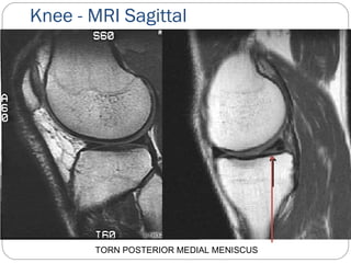 Knee - MRI Sagittal
TORN POSTERIOR MEDIAL MENISCUS
 