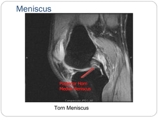 Meniscus
Torn Meniscus
 
