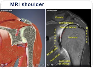 MRI shoulder
humerus
infraspinatus
S
c
a
p
u
l
a
Teres
m
inor
supraspinatus
D
e
lt
o
i
d
Clavicle
Glenoid labrum
Long Head
of Triceps
 