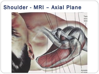 Shoulder - MRI – Axial Plane
 