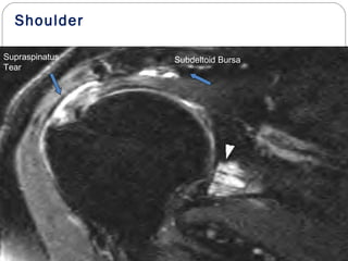 Shoulder
Supraspinatus
Tear
Subdeltoid Bursa
 