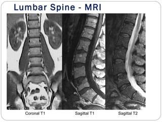 Lumbar Spine - MRI
Coronal T1 Sagittal T1 Sagittal T2
 