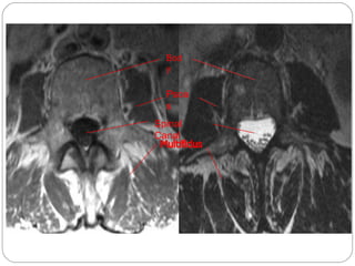 Bod
y
Psoa
s
Spinal
Canal
 