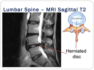 Herniated
disc
Lumbar Spine – MRI Sagittal T2
 