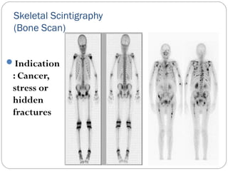 Skeletal Scintigraphy
(Bone Scan)
Indication
: Cancer,
stress or
hidden
fractures
 