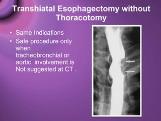 Esophaegeal resection & reconstruction | PPT