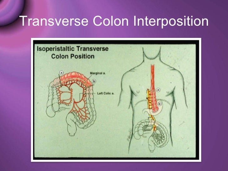 Esophaegeal resection & reconstruction