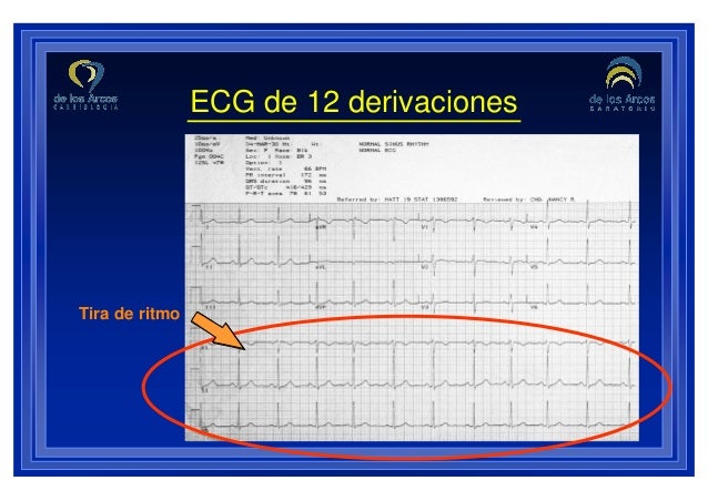 1. ecg 12_derivaciones_interpretación_esencial