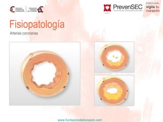 Fisiopatología Arterias coronarias 