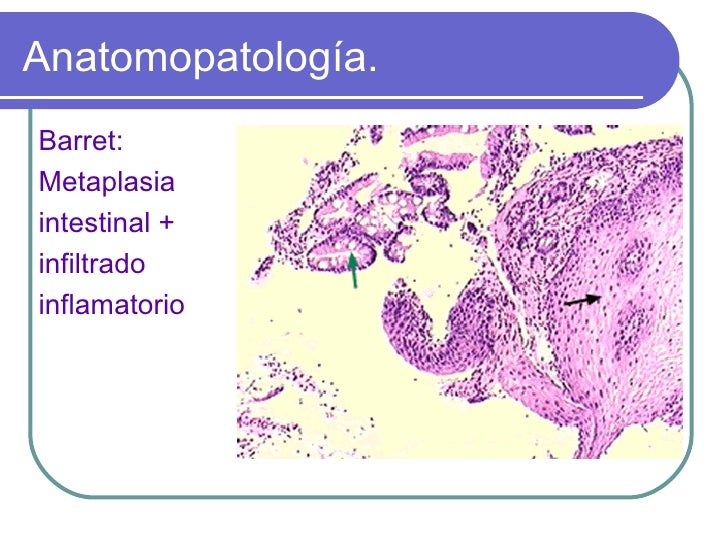 Hernia hiatal tipo 1 tratamiento Hernia hiatal tipo 1 tratamiento