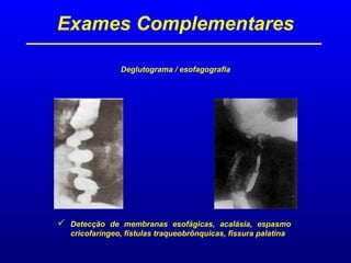 Exames Complementares
Deglutograma / esofagografia
 Detecção de membranas esofágicas, acalásia, espasmo
cricofaríngeo, fístulas traqueobrônquicas, fissura palatina
 