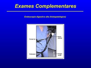Exames Complementares
Endoscopia digestiva alta (histopatológico)
 