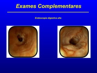 Exames Complementares
Endoscopia digestiva alta
 